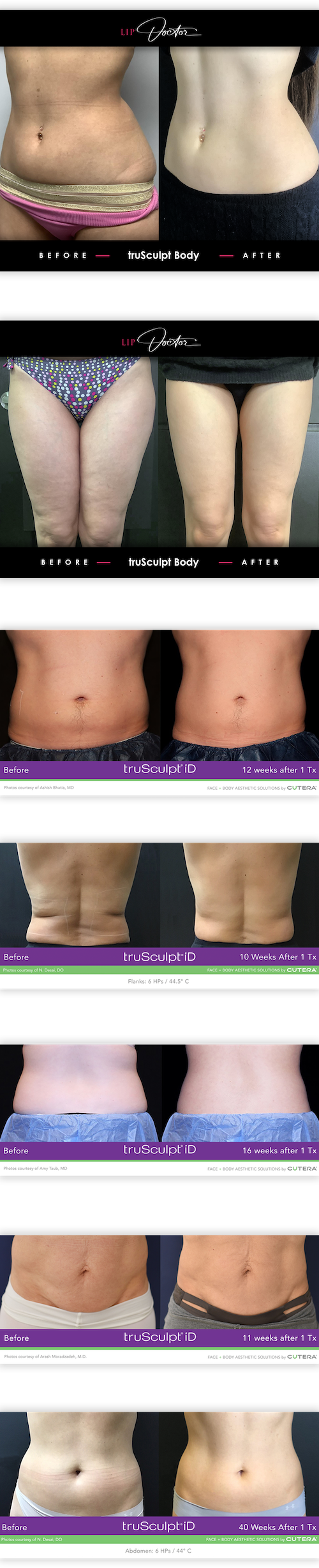 before after trusculpt mobile